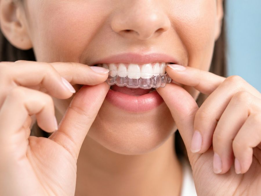 Paciente colocándose un alineador dental transparente