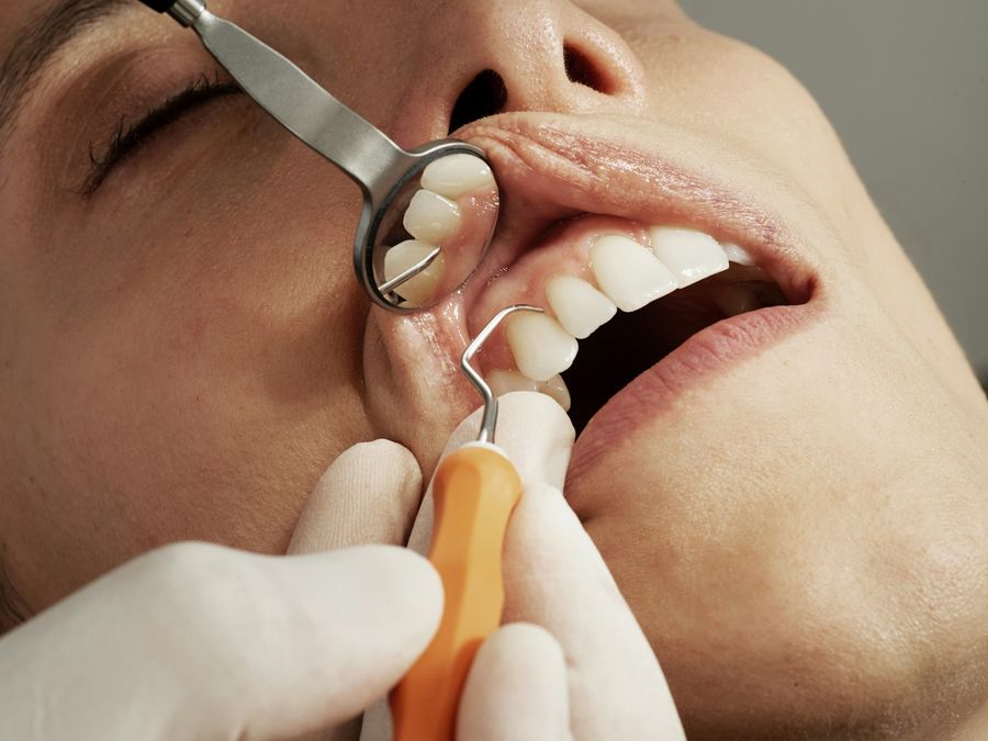 Examen de encías con espejo y sonda dental